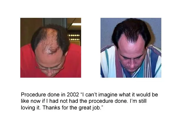 4000+ Grafts Before and After, 40 Year Old Male