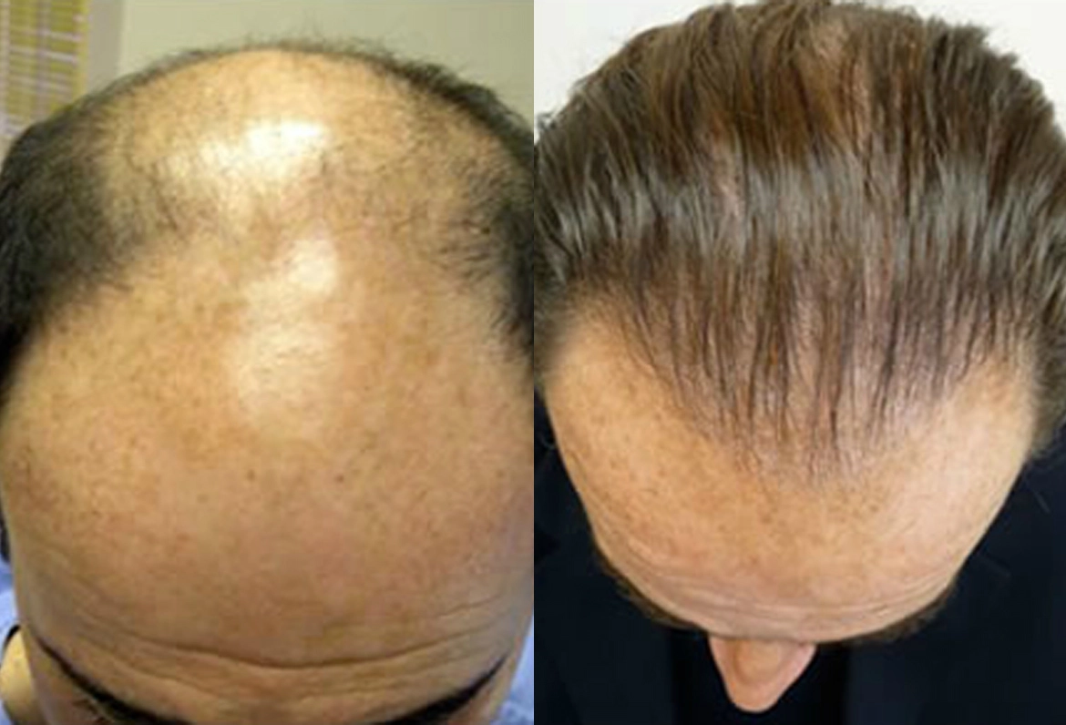 45 Year Old Male,3200 Grafts Before And After