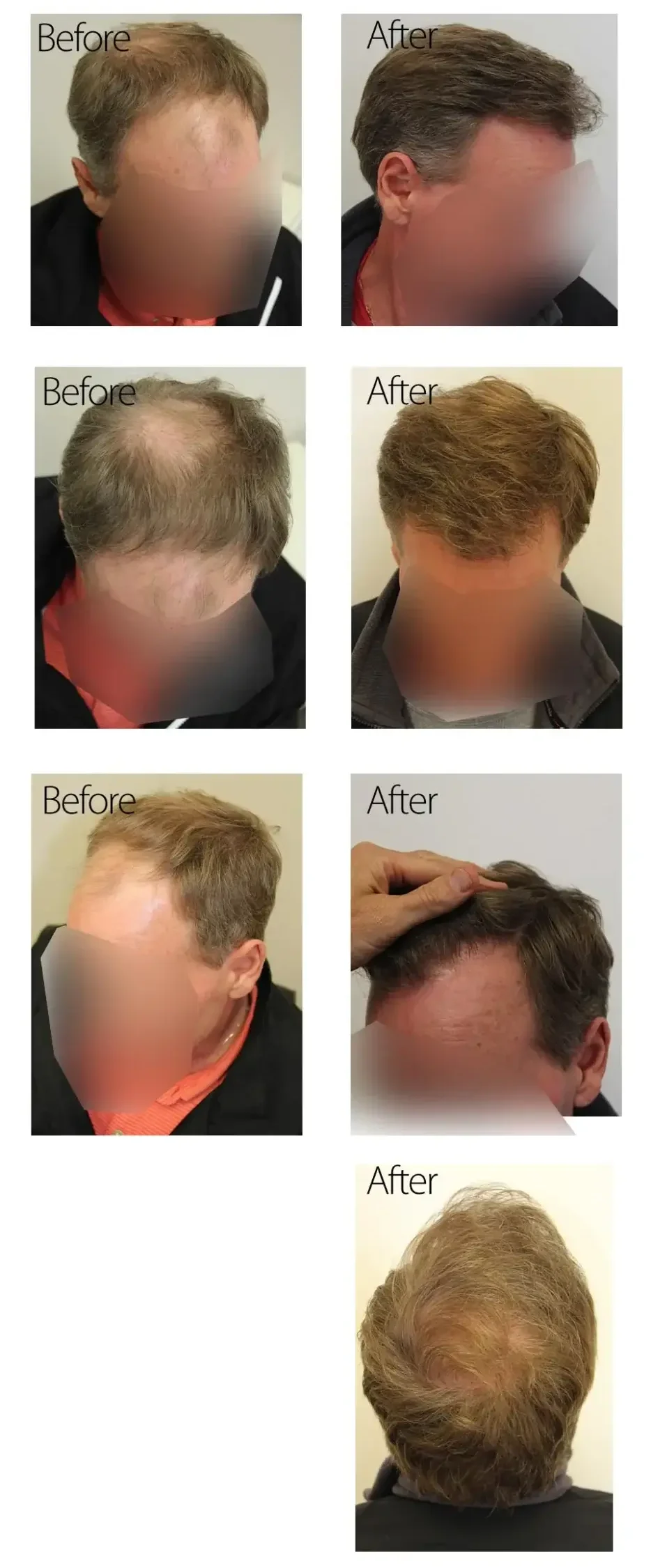 50 Year Old Male, Before And After Graft Strip Surgery,3078 Graft Strip 50 Year Old Male, Before And After Graft Strip Surgery,3078 Graft Strip