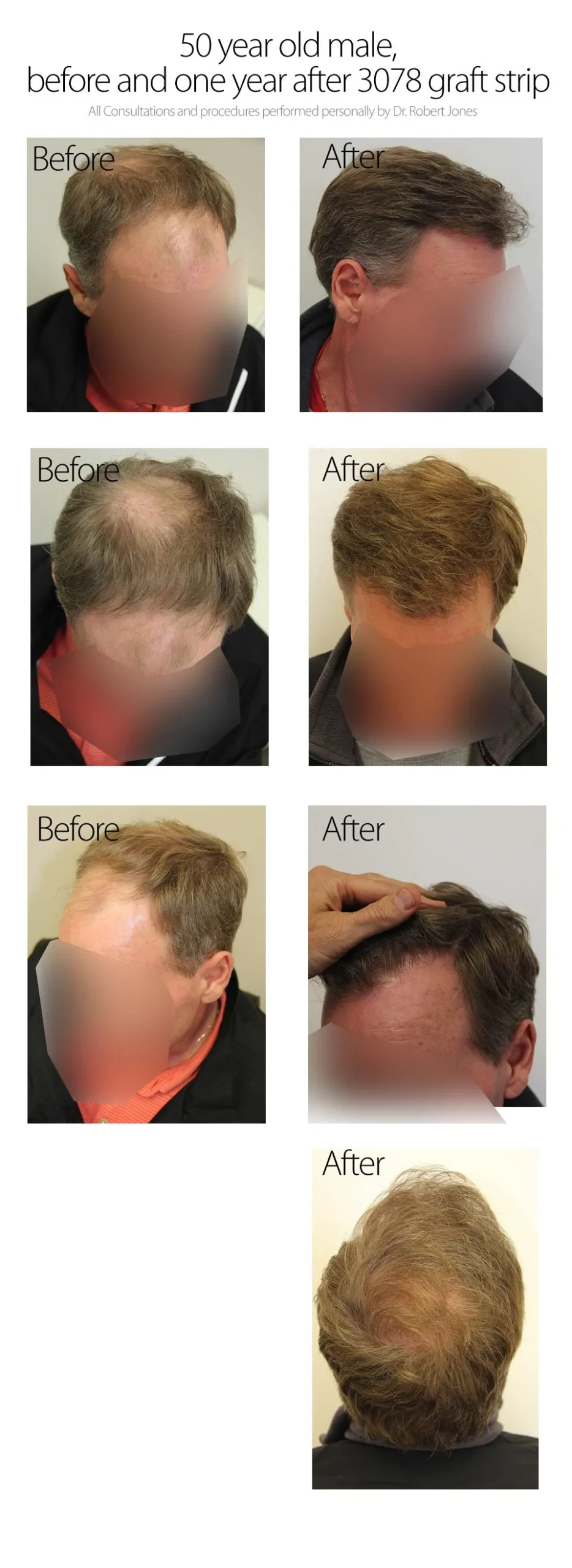 50 Year Old Male, Before And After Graft Strip Surgery,3078 Graft Strip 