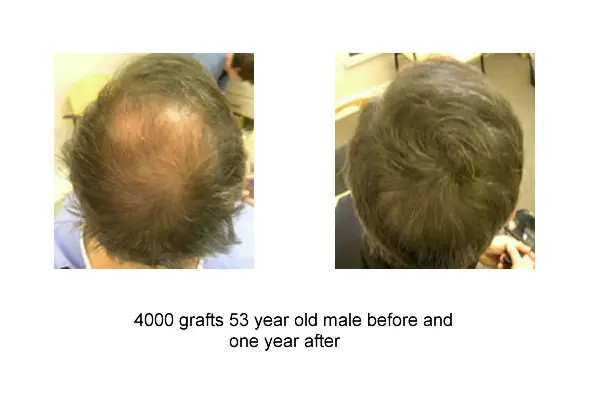 53 Year Old Male 4000 Grafts Before and After