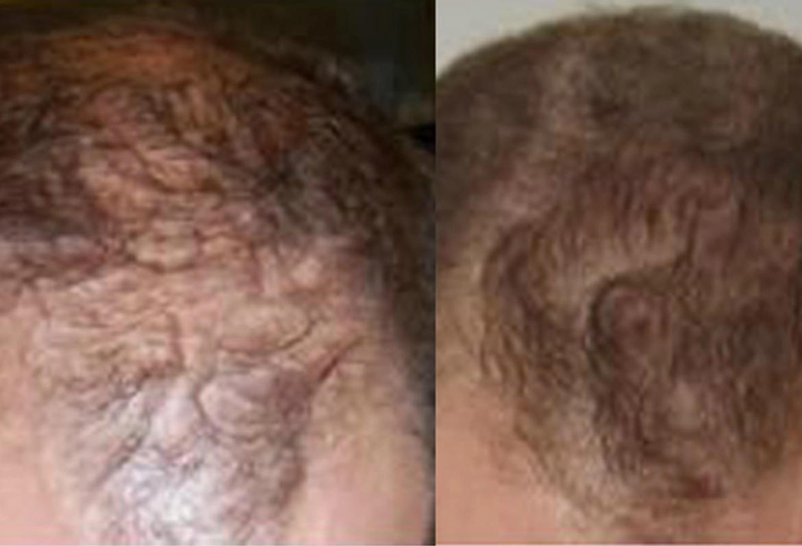 560 Grafts, Before And After