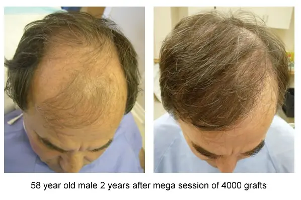 58 Year Old Male 2 Years After Mega Session Of 4000 Grafts