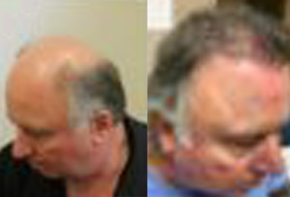 Hair Transplant Results - Toronto Hair Transplant Surgeons