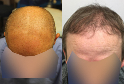 Hair Transplant Results - Toronto Hair Transplant Surgeons