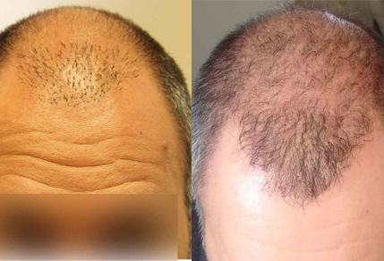 Before And After FUE Procedure, 42 Year Old Male, 3000 Grafts - Toronto ...