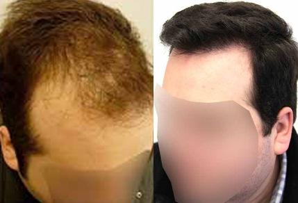Before And After Hair Transplant Procedure, 40 Year Old Male, 3700 Grafts - Toronto Hair Transplant Centre Before And After Hair Transplant Procedure, 40 Year Old Male, 3700 Grafts - Toronto Hair Transplant Centre