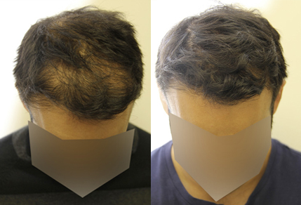 Before And After Graft Hair Transplant Procedure, 35 Year Old Male, 3500 Grafts - Toronto Hair Transplant Centre Before And After Graft Hair Transplant Procedure, 35 Year Old Male, 3500 Grafts - Toronto Hair Transplant Centre