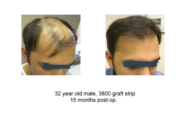 Before and After 3800 Graft Strip Procedure, 32 Year Old Male