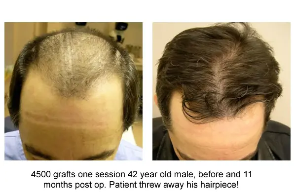 Before And After,42 Year Old Male,4500 Grafts