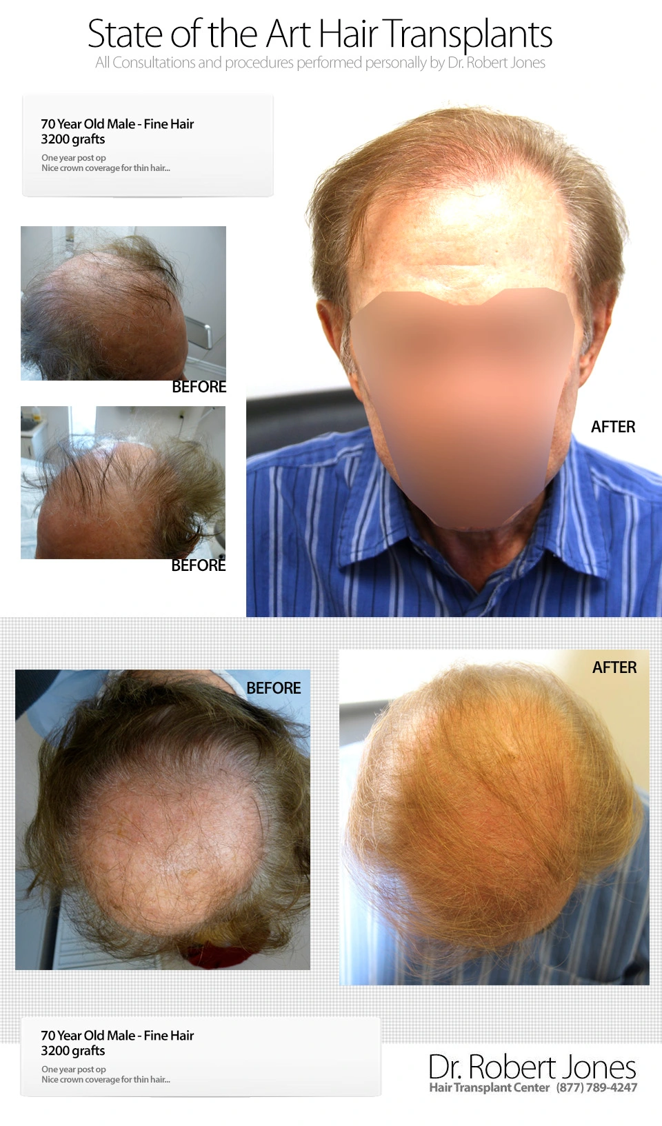 Before And After, 70 Year Old Male, 3200 Grafts