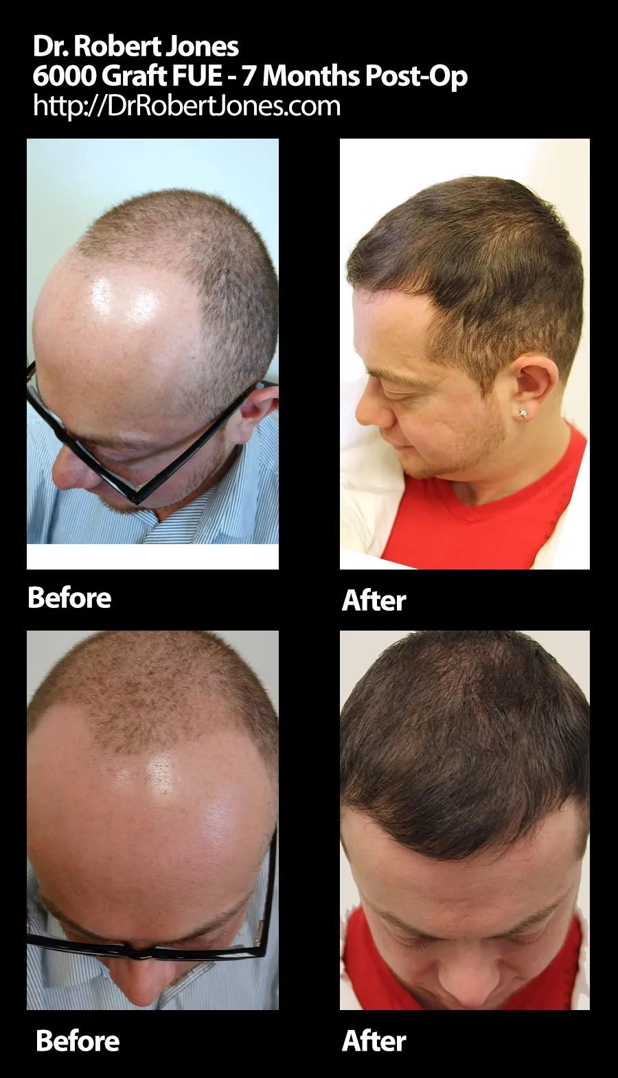 Before And After FUE Procedure, 6000 Grafts