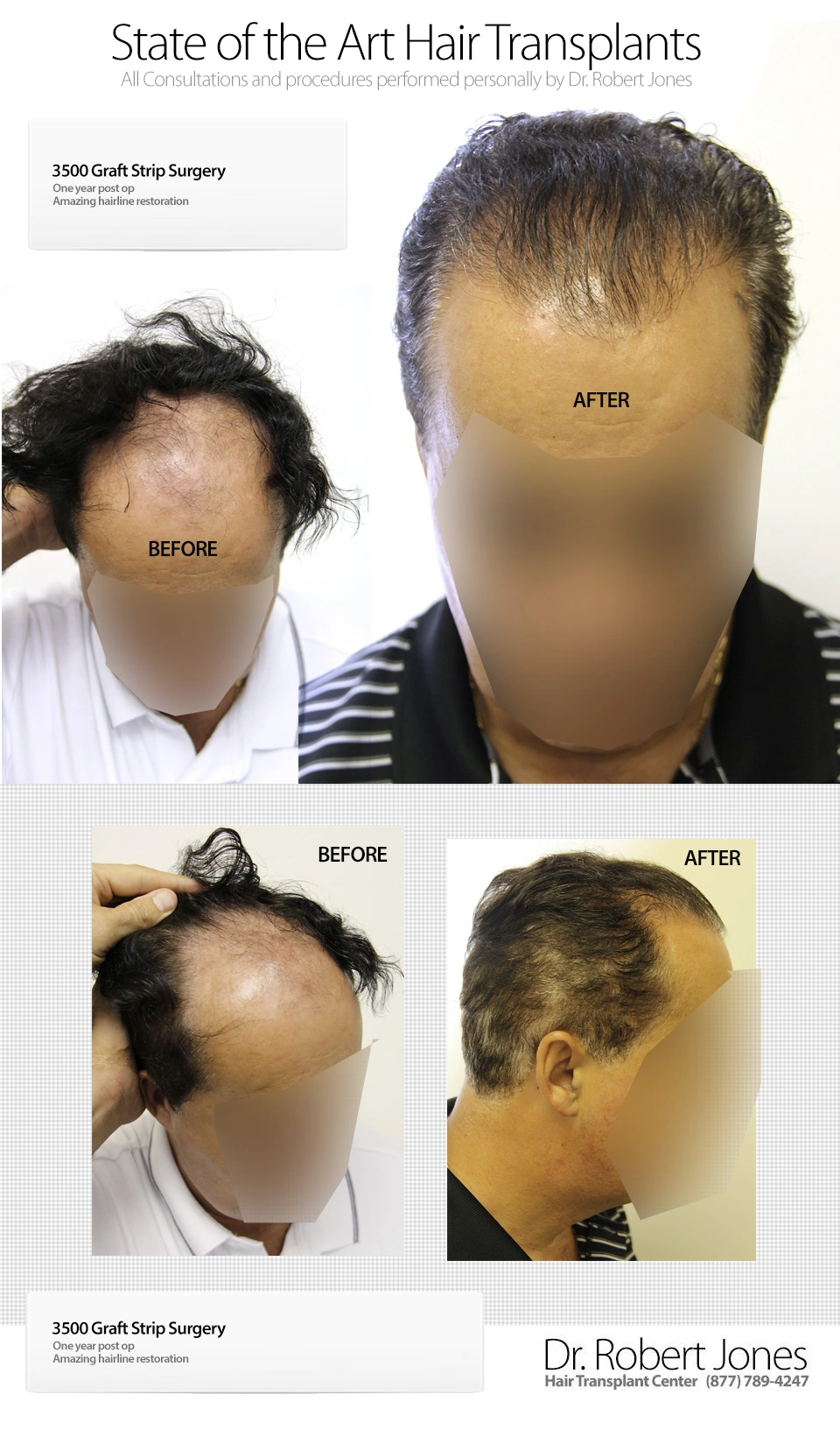 Graft Strip Surgery 3500 Grafts Before and After