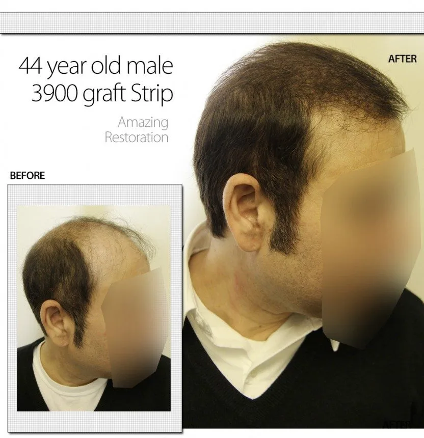 Graft Strip Surgery, 44 Year Old Male,3900 Grafts Before And After