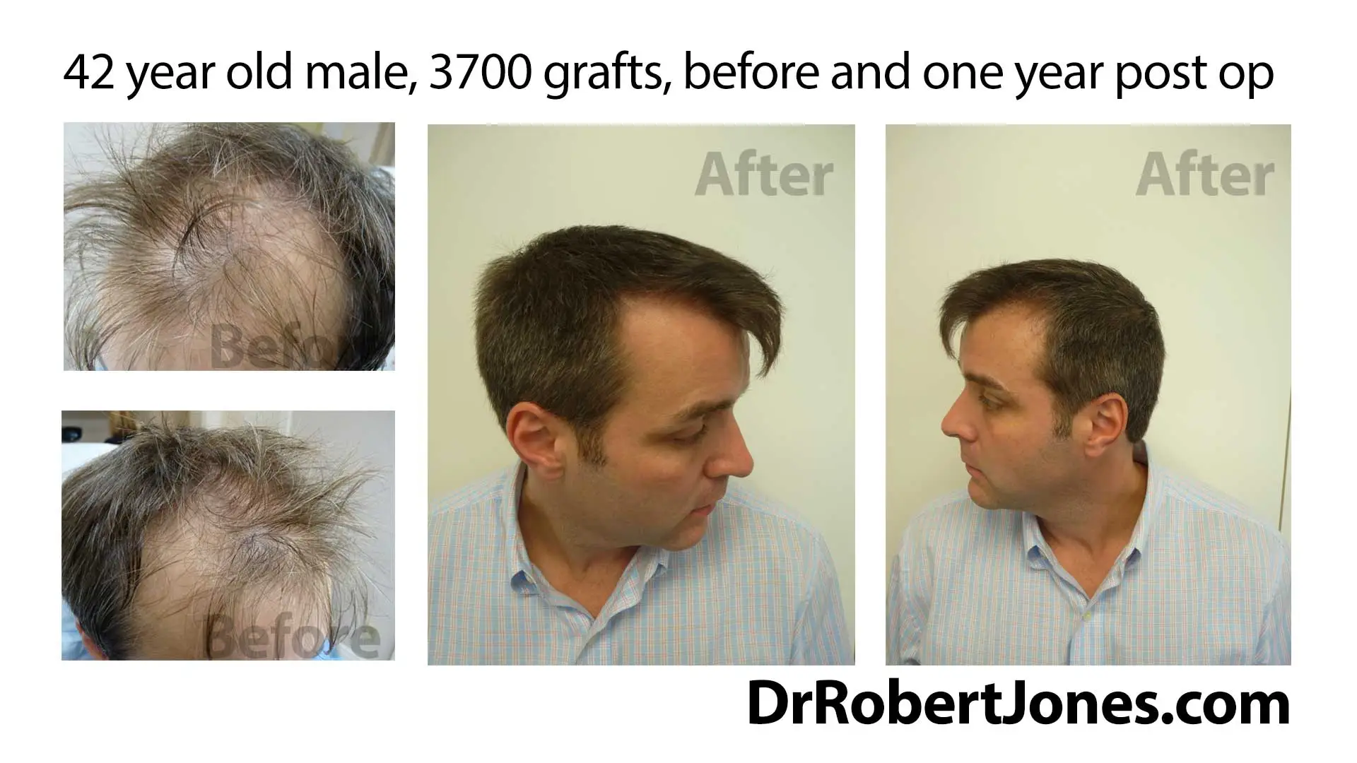 Hair Restoration Before And After, 3700 Grafts,42 Year Old Male