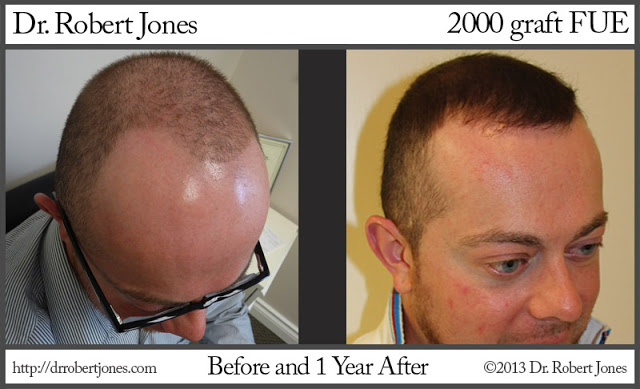 Before And After Hairline Transition, 2000 Grafts - Toronto Hair Transplant  Centre