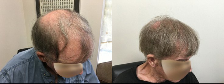 3000 Graft Strip 70 Year Old Male Before and One Year Post