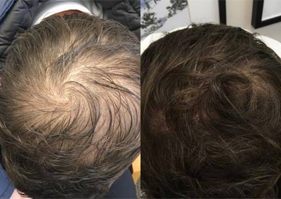 Before and after PRP