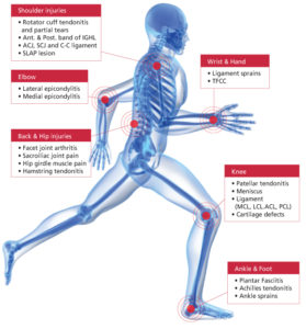 PRP-Injections