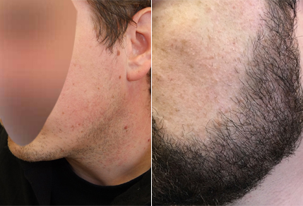 Before And After Beard Transplant Case Study