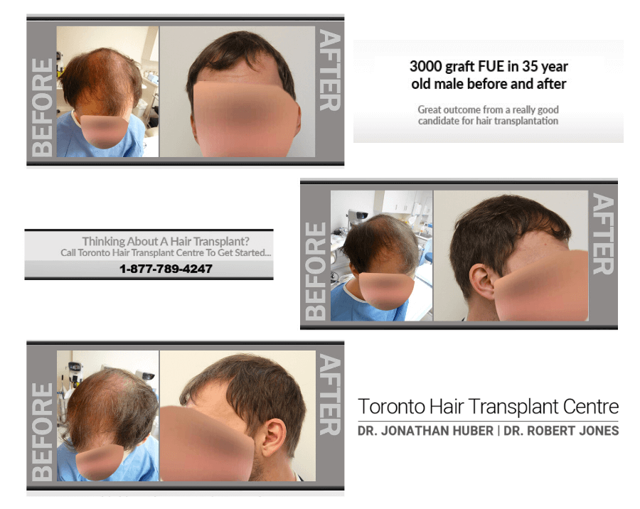 3000-Graft-FUE-Before-and-After