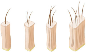 Follicular Units for Hair Transplant