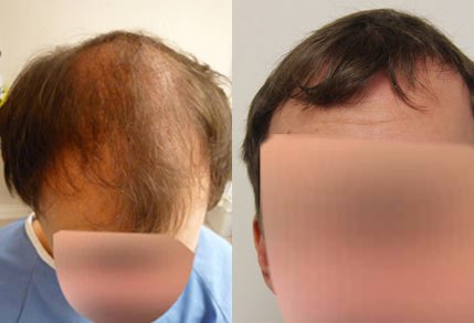 3000 Graft FUE Hair Transplant