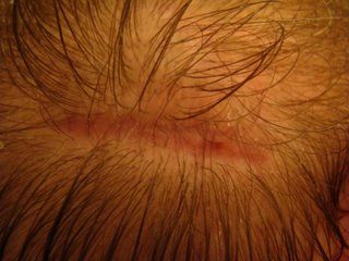 Acell Scar Repair Patient 12 Weeks Post OP