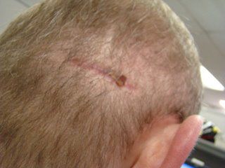 ACell Scar Repair Patient - December 19, 2008