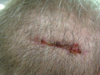 ACell Scar Repair Patient - Six Weeks