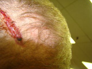 ACell Scar Repair Patient - Two Week Post-Op