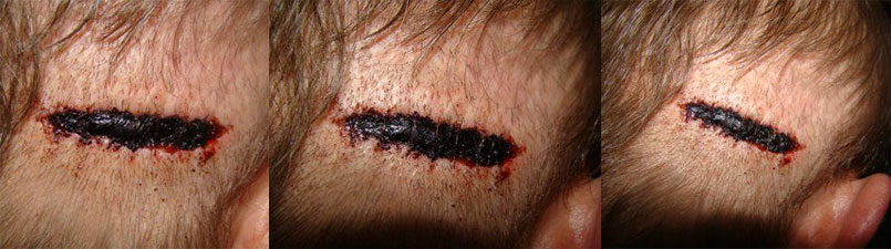 ACell Scar Repair Treatment