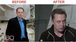 Elon Musk's Hair Transplant | Toronto Hair Transplant Centre