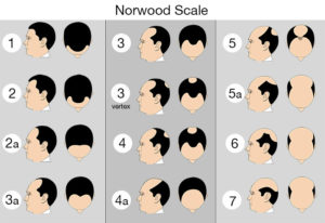 norwood scale