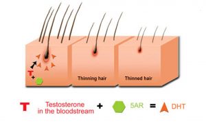 DHT-Hair-Transplants-Toronto-300x183