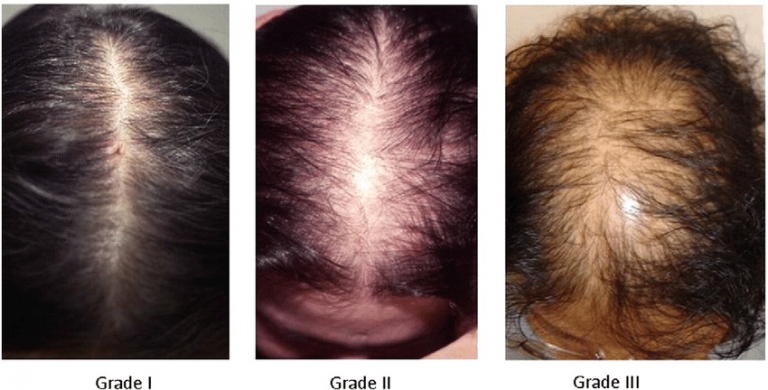 Androgenetic Alopecia in Women  ScienceDirect