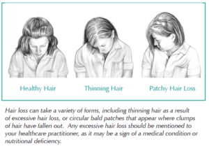 Type of Hair loss in women 
