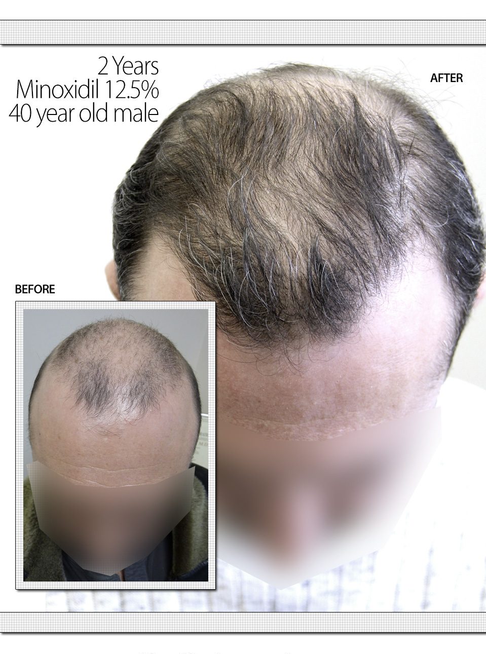 Hair Regrowth With Minoxidil % – 2 Years - Toronto Hair Transplant  Centre