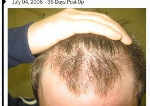 technique-of-hair-transplants-img2
