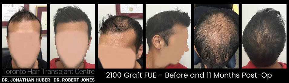 Toronto Hair Transplant Surgeons - Male 2100 Graft FUE and PRP