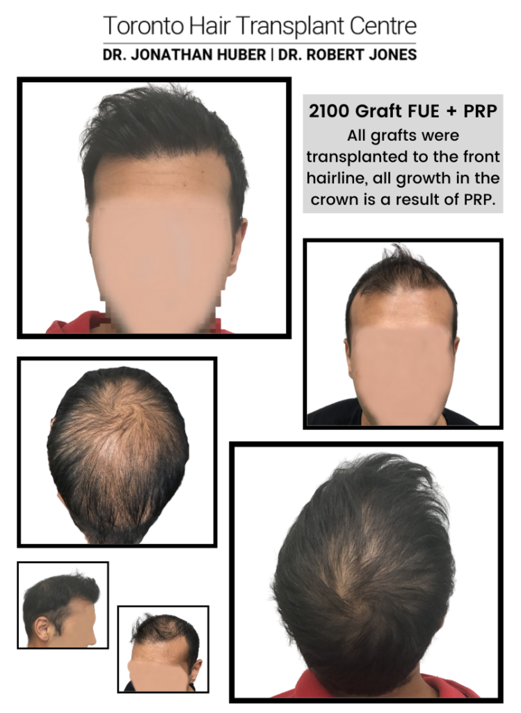 PRP and FUE - 2100 grafts