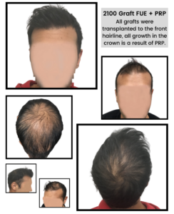 PRP and FUE - 2100 grafts