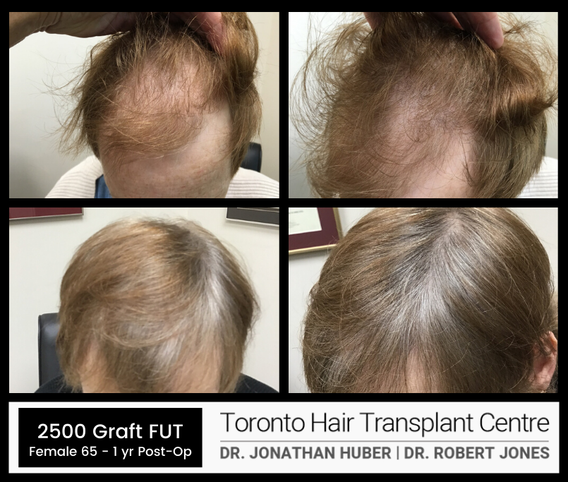 Toronto Hair Transplant Surgeons - FUT - Before and After - Female - 2500 Grafts