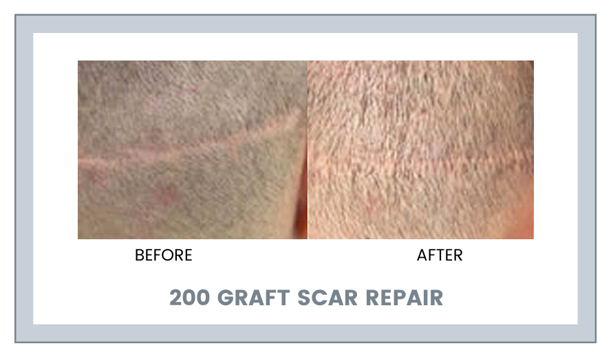 200 GRAFT SCAR REPAIR