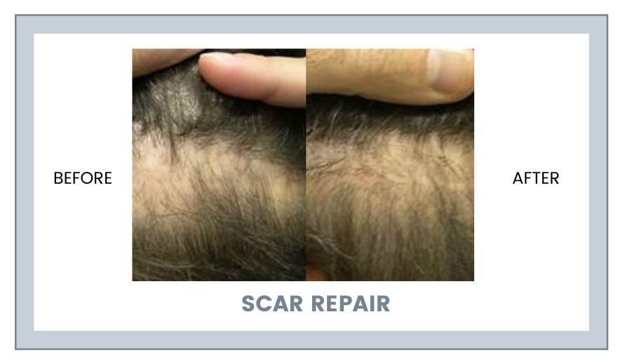 SCAR REPAIR