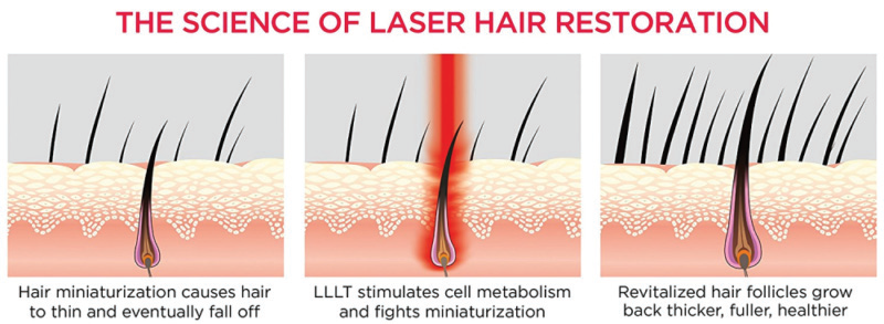 BIOLIGHT - The Science of Laser Light Hair Restoration