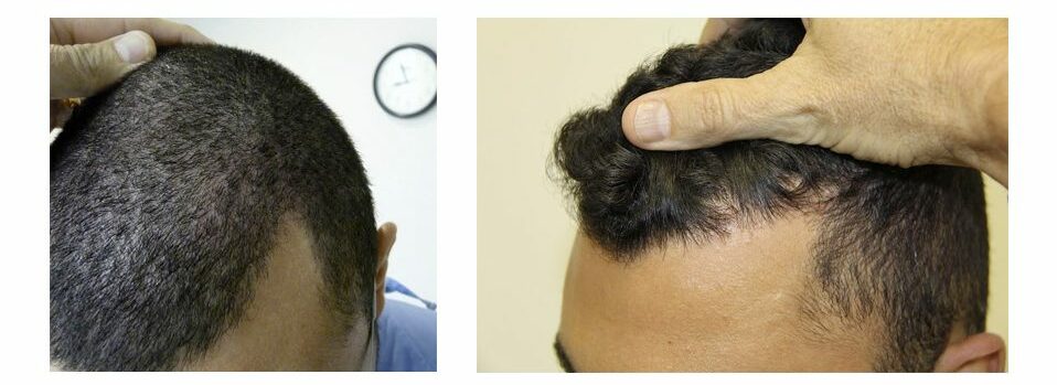 1500 graft scar repair and hairline enhancement