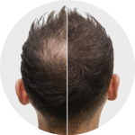 Our Results | Toronto Hair Transplant Suregons