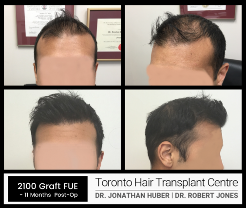 Before And After - 2100 Grafts FUE + PRP - Toronto Hair Transplant Centre