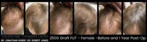 Toronto Hair Transplant Surgeons - Female FUT - Before and After 2500 Grafts